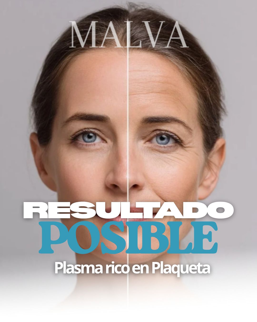 Tratamiento facial de Plasma Rico en Plaquetas